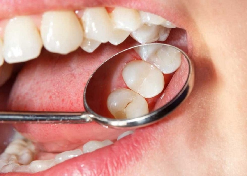 Răng sâu bị vỡ chỉ còn chân răng điều trị bằng cách nào? 1