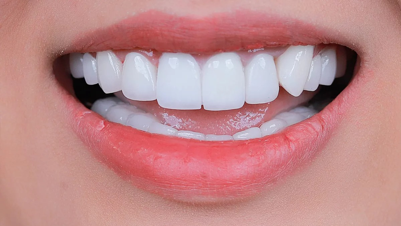 Răng sâu bị vỡ chỉ còn chân răng điều trị bằng cách nào? 4