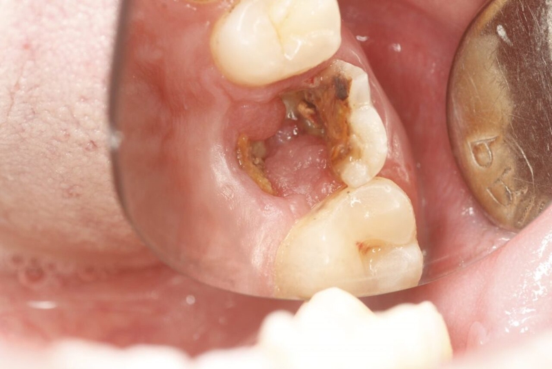 Một số bệnh về răng miệng phổ biến mà bạn cần phải chú ý1