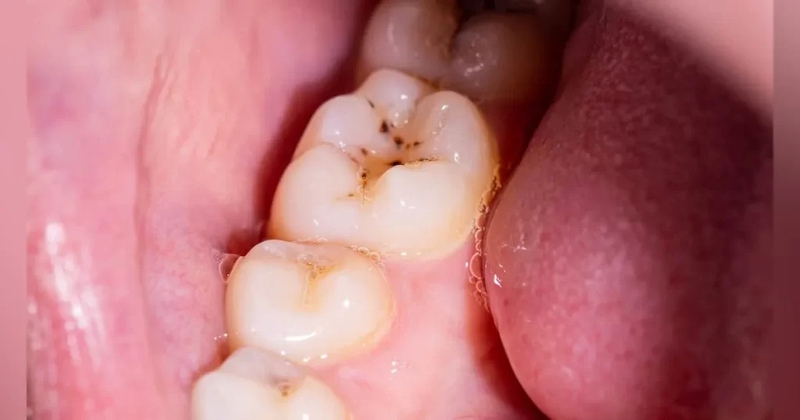 Răng sâu nên làm gì? 1