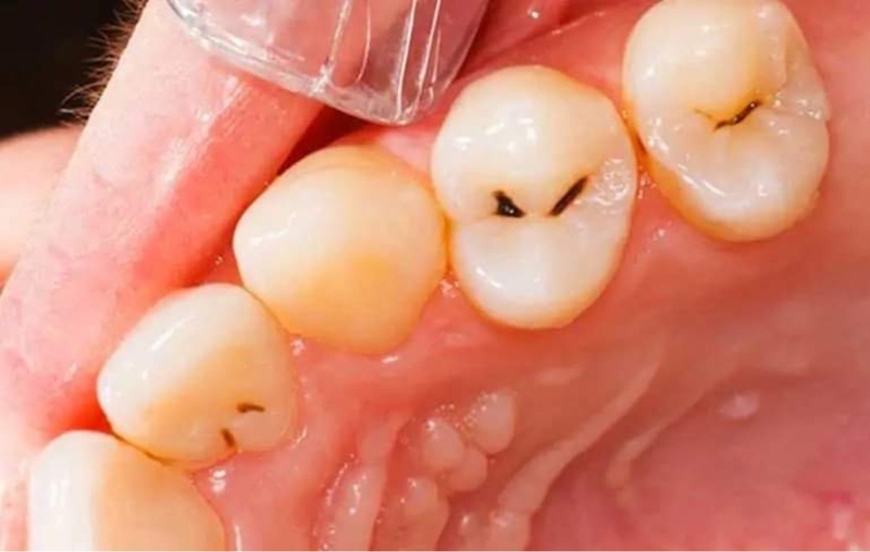 Răng sâu nên làm gì? 2
