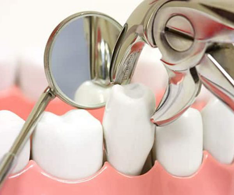 Răng số 4 là gì? Nhổ răng số 4 có ảnh hưởng gì không? 3