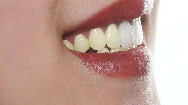 Răng sứ có bị ố vàng không? Những điều bạn cần biết 3