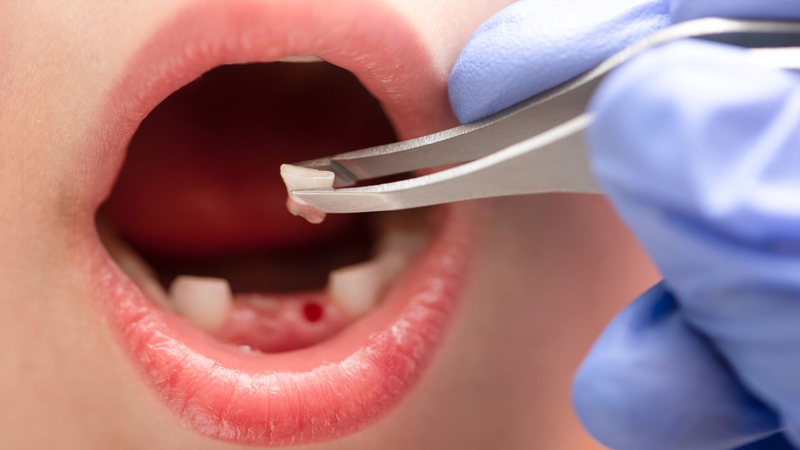 Răng sữa bị sâu có nên nhổ không? Quy trình xử lý thế nào? 1
