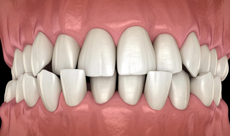 Răng vĩnh viễn mọc lệch vào trong: Nguyên nhân và dấu hiệu nhận biết 1