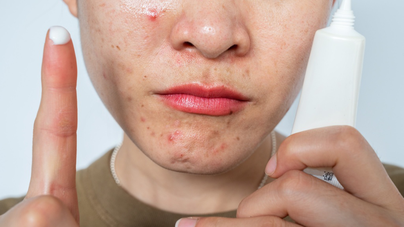 Retinol và Tretinoin khác nhau như thế nào? Những lưu ý khi dùng 3