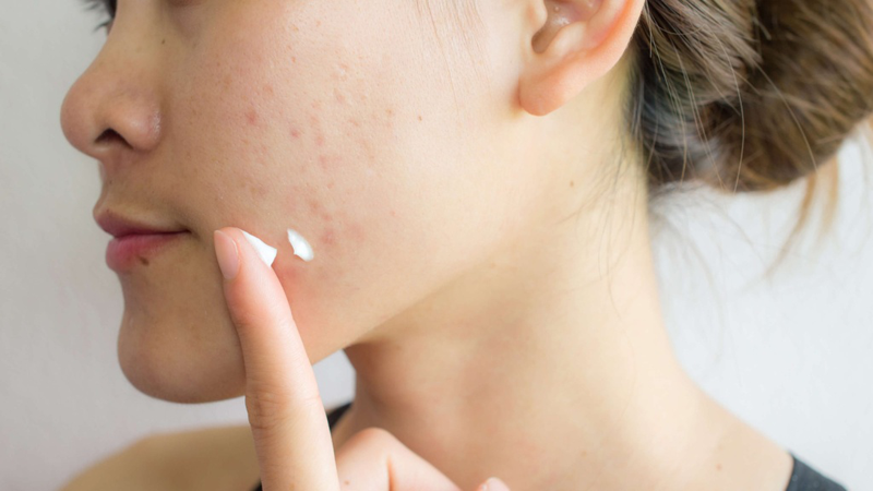 Retinol và Tretinoin khác nhau như thế nào? Những lưu ý khi dùng 5