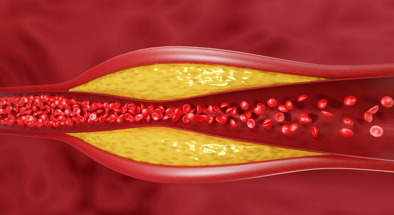 Rối loạn chuyển hóa lipid gây bệnh gì? Phương pháp chẩn đoán và điều trị 1