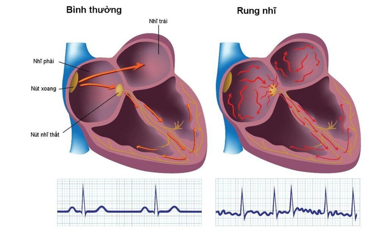 Rối loạn nhịp tim trong nhồi máu cơ tim là gì? Biện pháp phòng tránh bệnh nhồi máu cơ tim 3