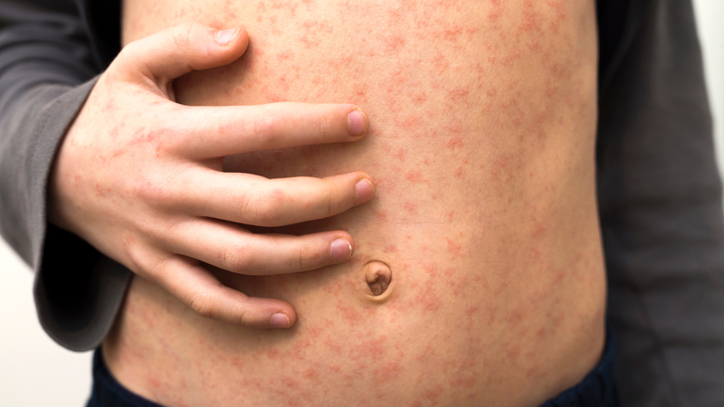 Rubella có phải là bệnh sởi không? Cách phòng bệnh Rubella hiệu quả 1