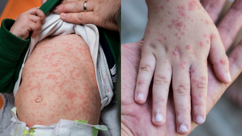 Rubella có phải là bệnh sởi không? Cách phòng bệnh Rubella hiệu quả 4