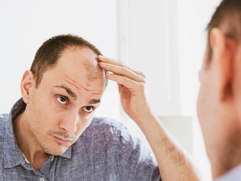 Rụng tóc nhiều ở nam giới: Nguyên nhân, dấu hiệu và ngăn ngừa