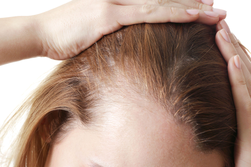 Rụng tóc Telogen là gì? Cách khắc phục tình trạng này 3
