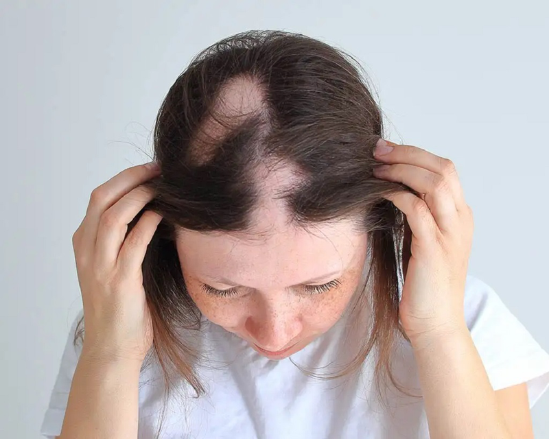 Rụng tóc toàn thể là gì? Nguyên nhân và cách chữa trị 2