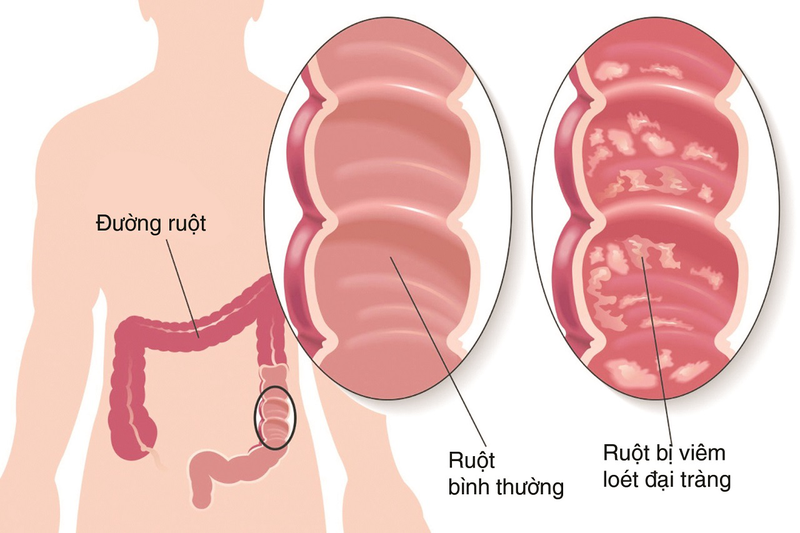 Viêm loét đại trực tràng gây tổn thương nông tại lớp niêm mạc và lớp dưới niêm mạc