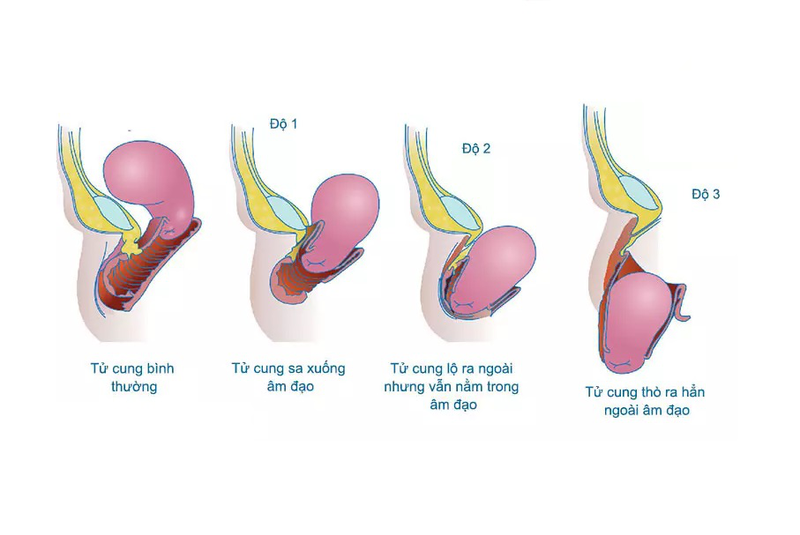 Biến Chứng Nguy Hiểm