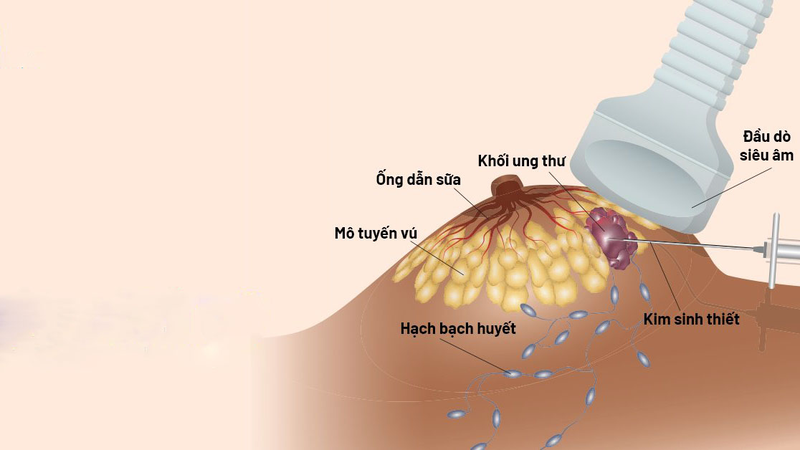 Sang thương vú BIRADS 2 là gì? Có nguy hiểm không? 3