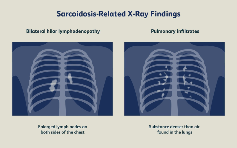 Sarcoidosis là gì? Nguyên nhân và cách điều trị bệnh sarcoidosis 5