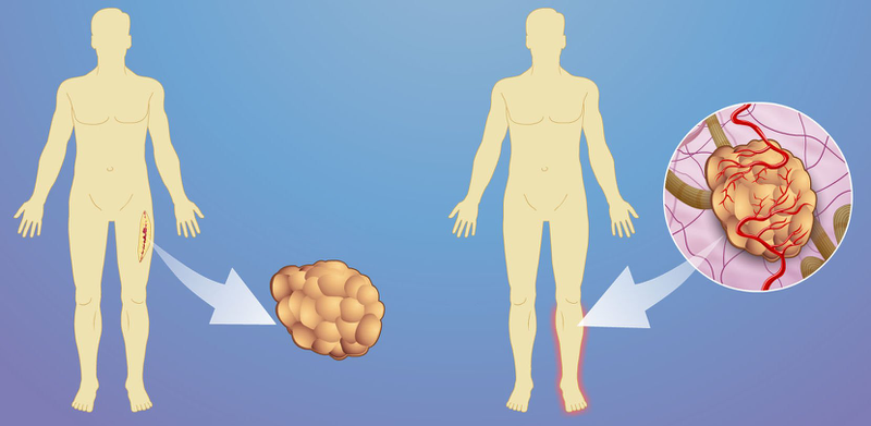 Sarcoma mô mềm sống được bao lâu? 4