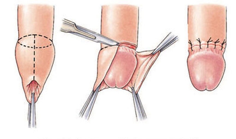 Sau cắt bao quy đầu có tăng kích thước không? Cách chăm sóc vết mổ mà nam giới nên biết 1