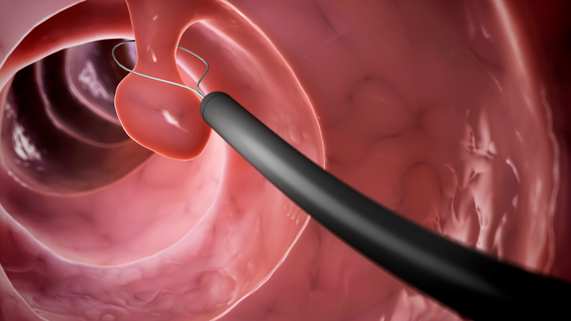 Sau cắt polyp dạ dày nên ăn gì để nhanh hồi phục?2
