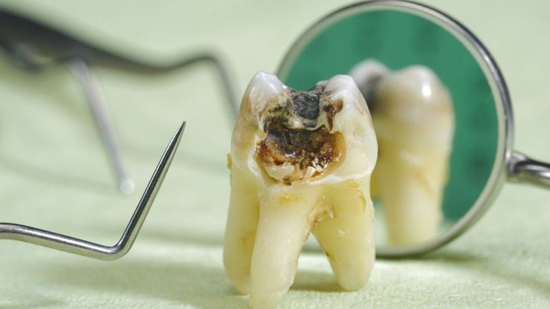 Sâu răng nặng là gì? Cách trị sâu răng nặng hiệu quả 1