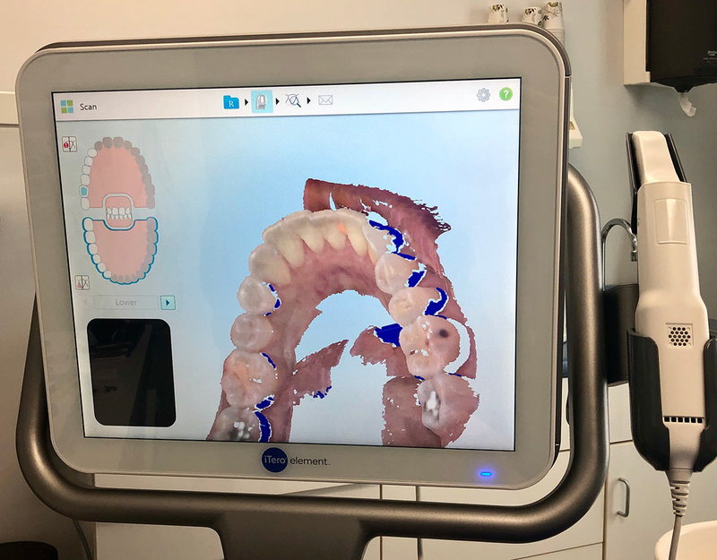 Scan răng 3d là gì? Quy trình scan răng 3d ra sao? 1