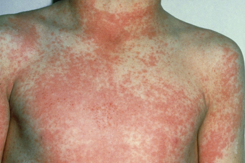 Scarlet fever là gì? Nguyên nhân, triệu chứng, chẩn đoán và điều trị Scarlet fever 1