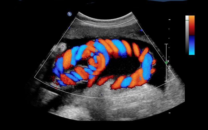 Siêu âm Doppler thai 32 tuần: Khi nào cần thực hiện? 1