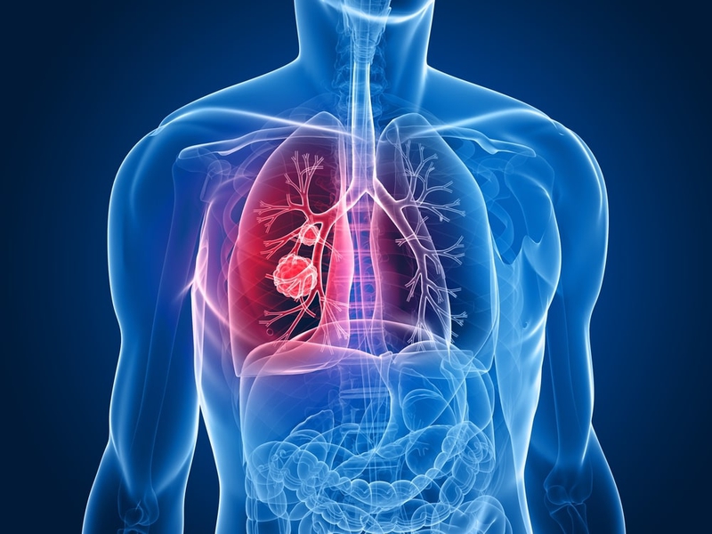 Sinh thiết phổi là gì? Sinh thiết phổi bao lâu thì có kết quả? 3
