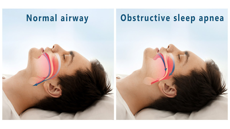 Sleep apnea là gì? Sleep apnea có nguy hiểm không? 1