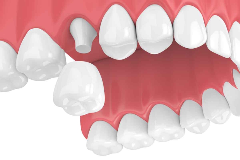 Bọc sứ 16 răng là gì? Chất liệu nào thường được sử dụng để bọc sứ? 1