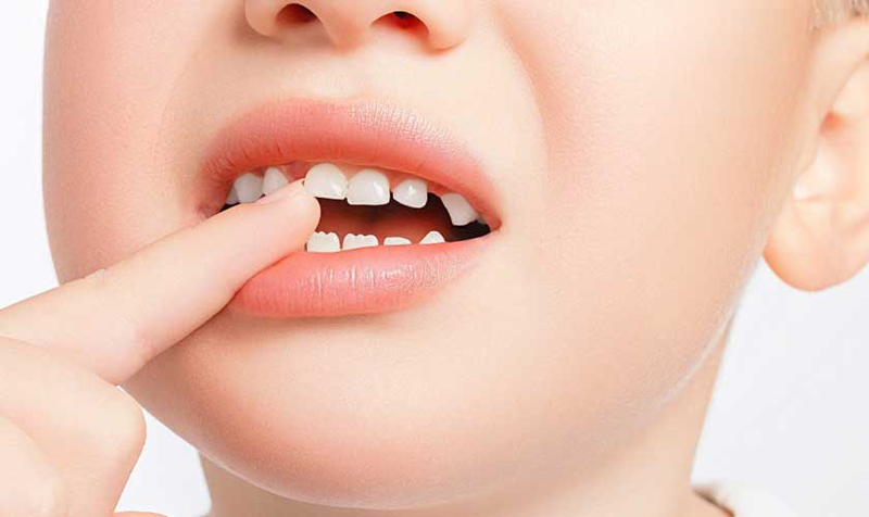 Những lưu ý về giai đoạn răng hỗn hợp ở trẻ 1