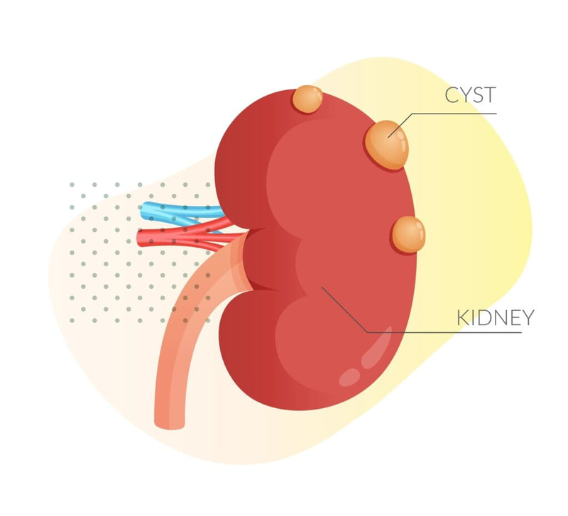 Tìm hiểu về phẫu thuật nội soi cắt chỏm nang thận 1