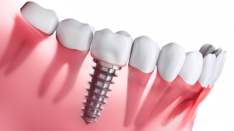  So sánh các loại trụ Implant 1