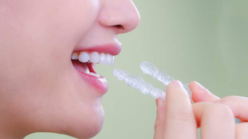 So sánh niềng răng Zenyum và Invisalign: Nên chọn phương pháp nào? 2