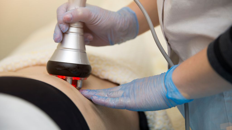 So sánh triệt lông nóng và lạnh: Nên chọn phương pháp nào? 3