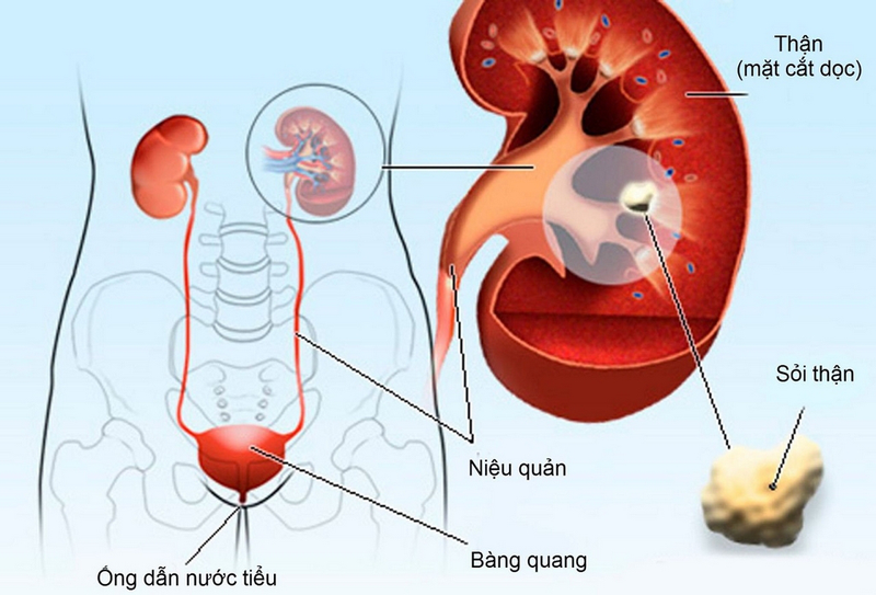 Nguyên nhân, triệu chứng và phương pháp điều trị bệnh sỏi niệu đạo 1