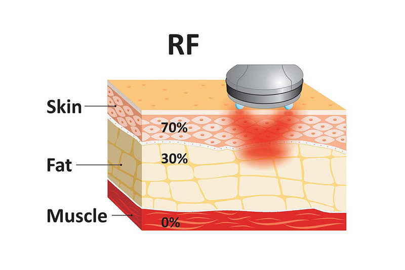 Sóng RF là gì? Sóng RF có tác dụng gì trong lĩnh vực làm đẹp 2