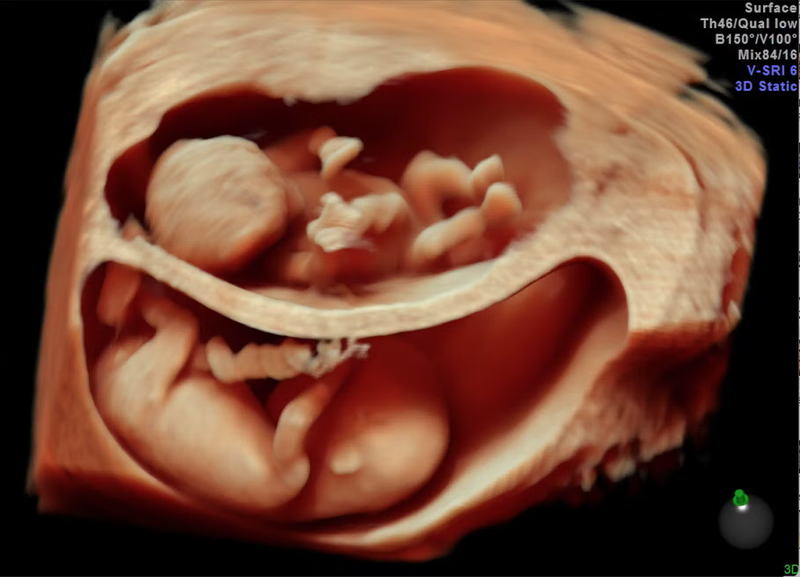 Song thai 2 nhau 2 ối là dạng song thai an toàn nhất