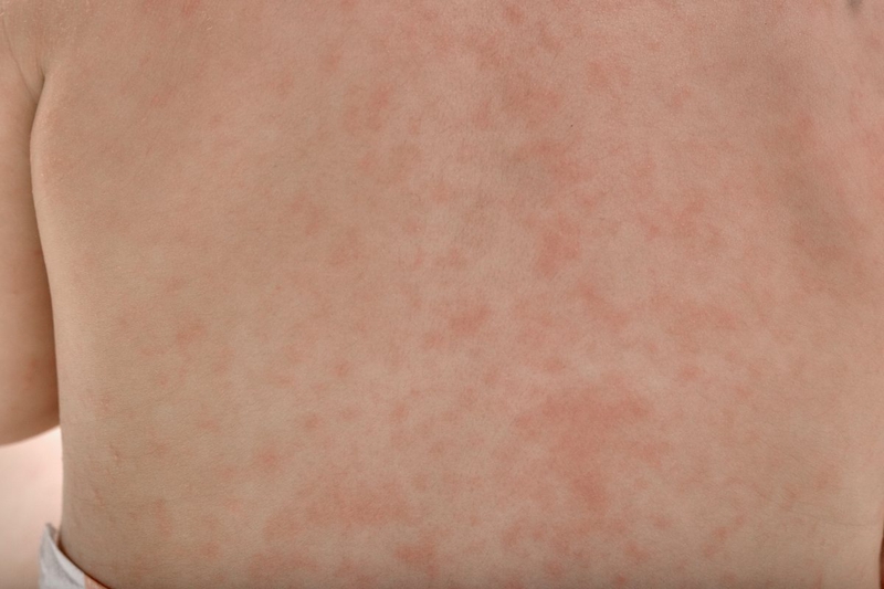 Sốt phát ban là một trong những biểu hiện của sốt do sử dụng thuốc gây ra