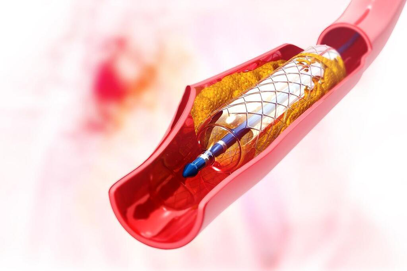 Phương pháp tái tưới máu là gì? Các biện pháp điều trị thiếu máu cơ tim mà bạn nên biết 2