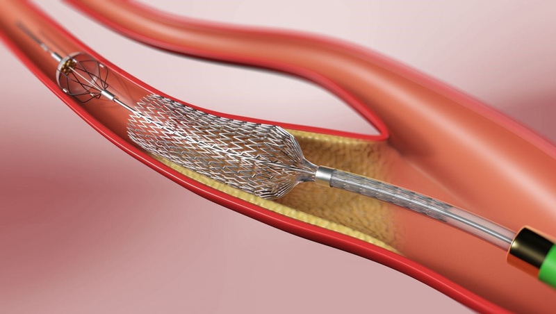 Stent và phẫu thuật bắc cầu - hai phương pháp can thiệp điều trị bệnh mạch vành 2