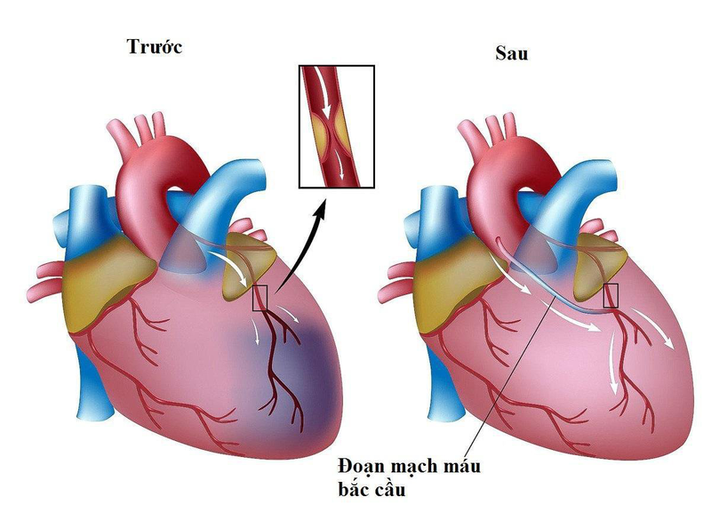 Stent và phẫu thuật bắc cầu - hai phương pháp can thiệp điều trị bệnh mạch vành 3