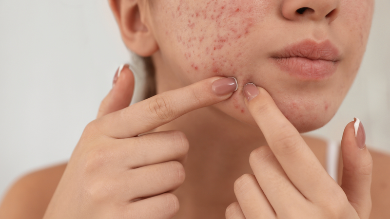 Sữa rửa mặt trị mụn ẩn nào tốt hiện nay? Top 5 sản phẩm được các chuyên gia làm đẹp khuyên dùng 4