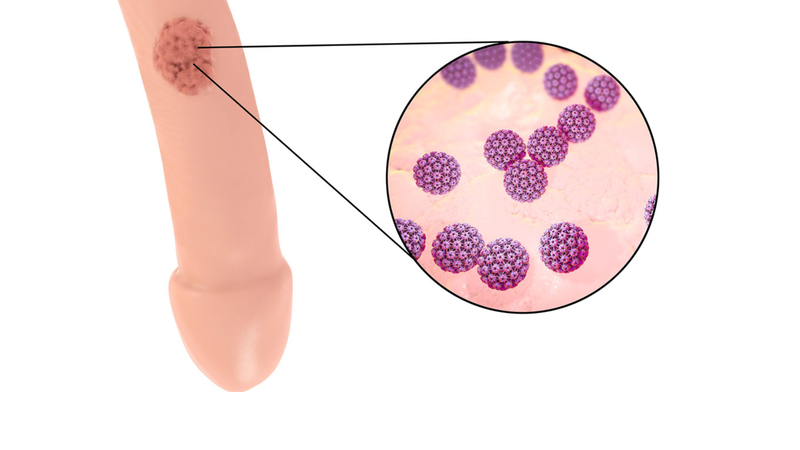 Sùi mào gà dương vật​ là gì? Cách điều trị và phòng ngừa sùi mào gà dương vật 4