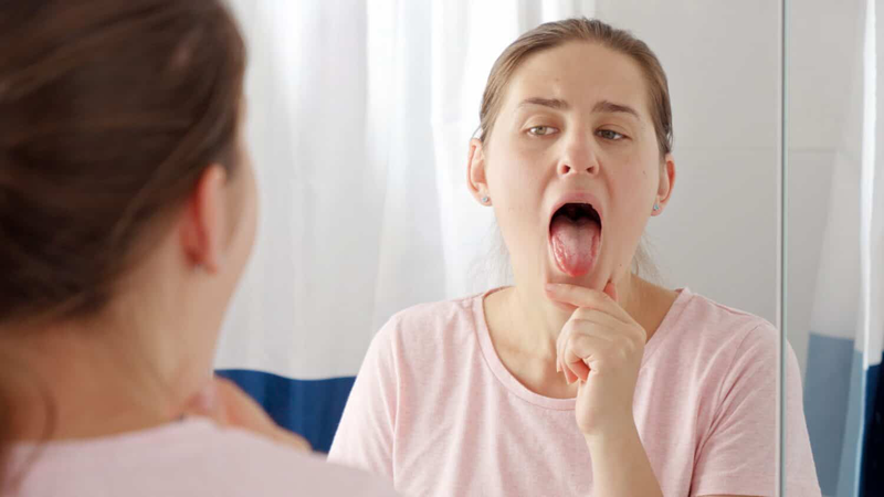 Sùi mào gà ở lưỡi giai đoạn đầu có dấu hiệu gì? - 3