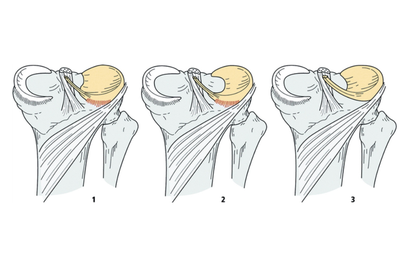 Sụn chêm hình đĩa có mấy loại và biện pháp điều trị như thế nào? 2