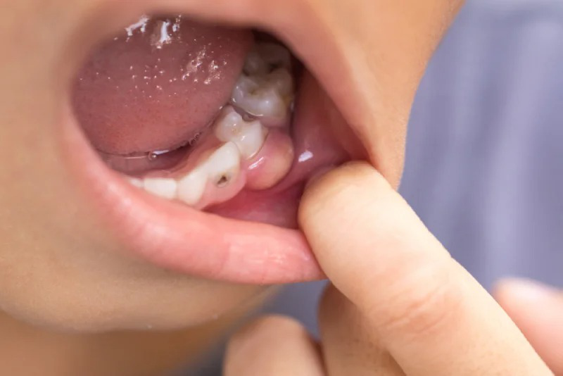 Sưng mộng răng là gì? Nguyên nhân gây ra sưng mộng răng?