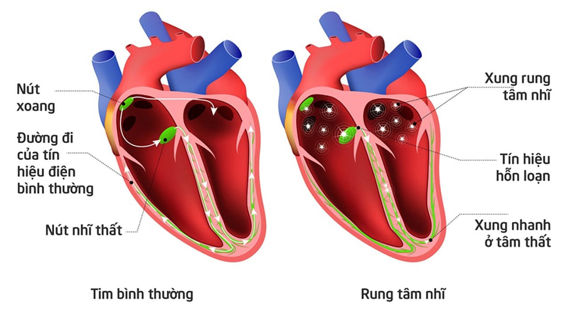Suy nút xoang tim: Nguyên nhân, chẩn đoán và phương pháp điều trị 1